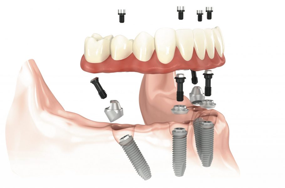 Имплантация зубов ALL-ON-4