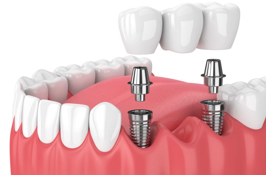 Протезирование зубов на имплантах